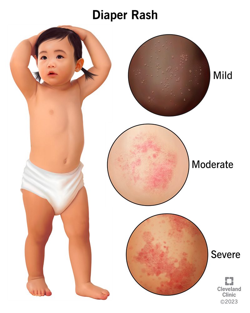 Allergic Reaction Diaper Rash