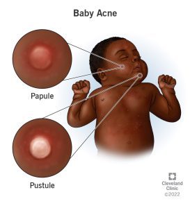 Baby Acne Self-Care