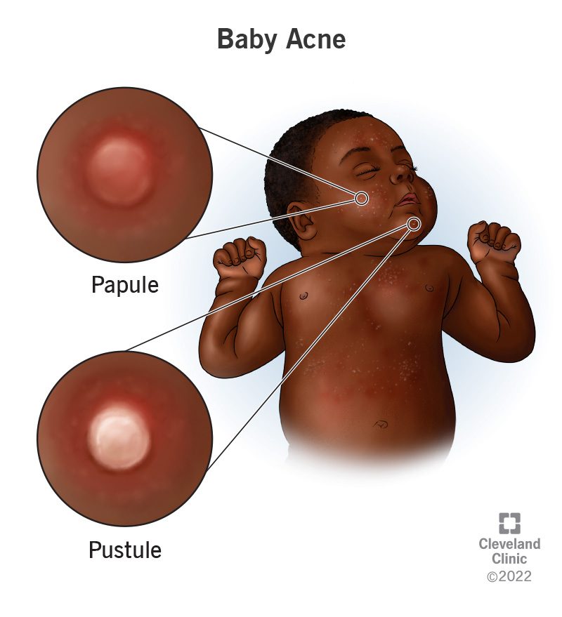 Baby Acne Self-Care