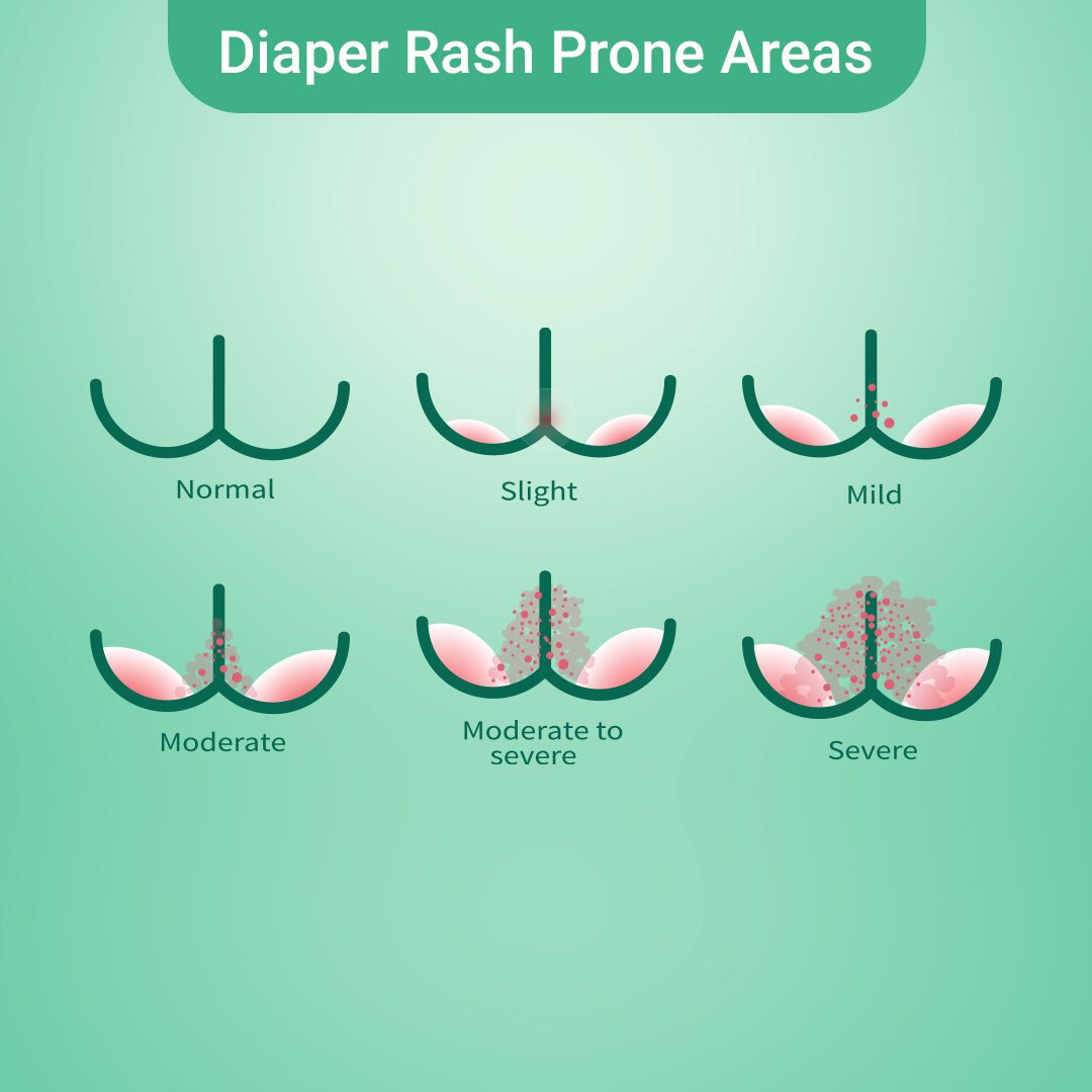 Female Diaper Rash Pictures