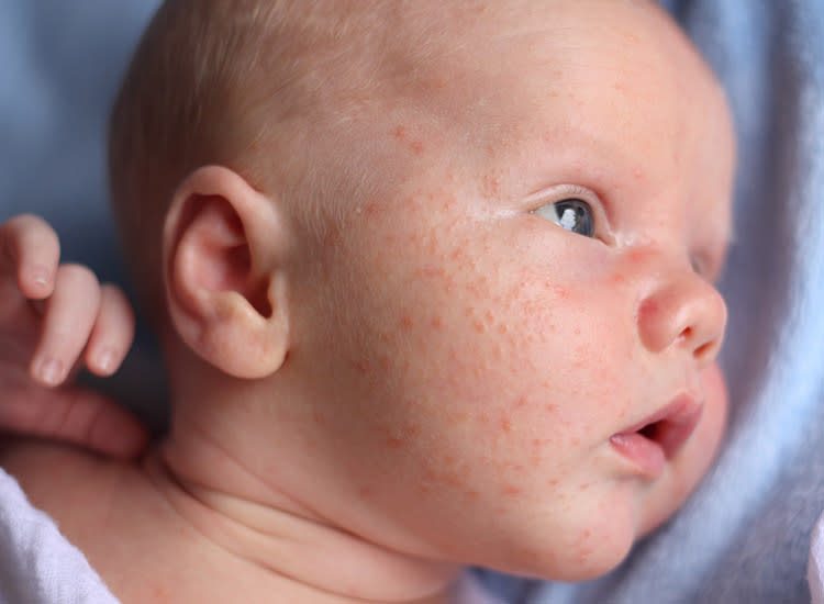 Heat Rash on Baby'S Face