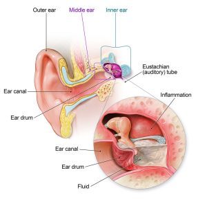 How Do Babies Get Ear Infections