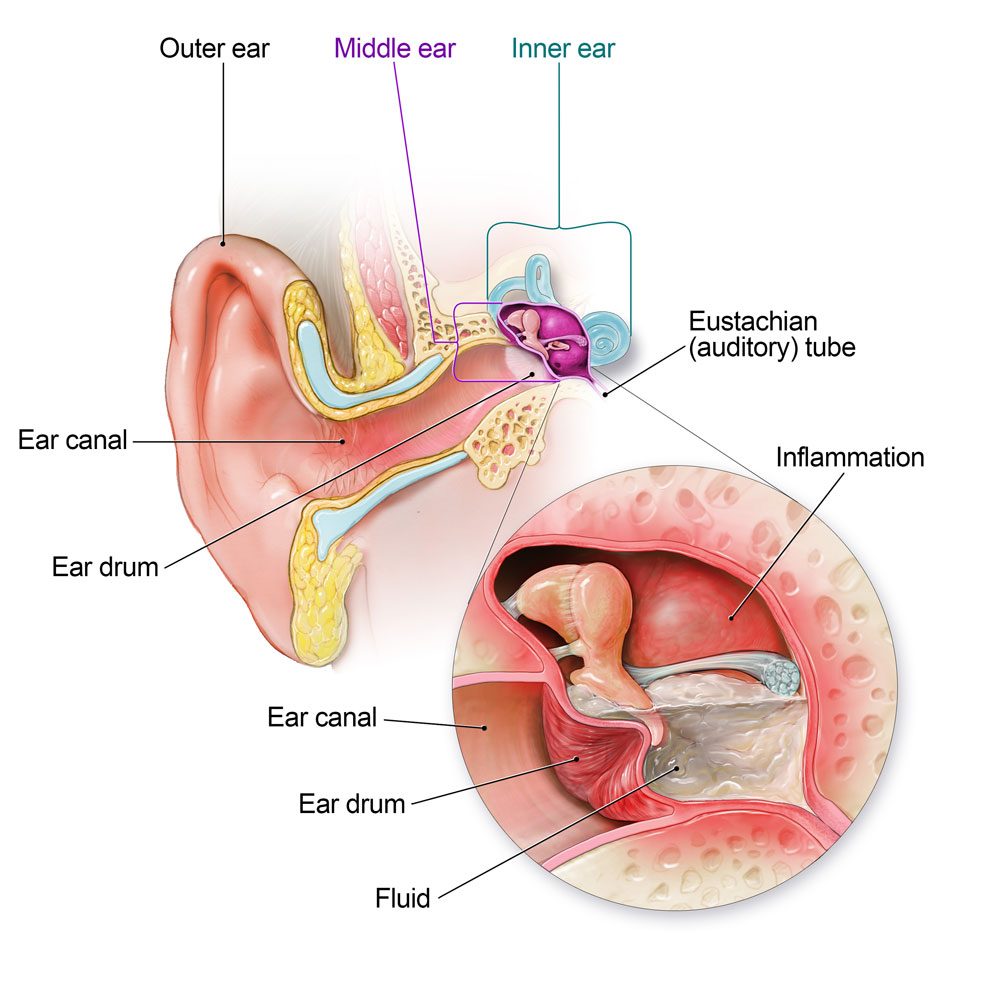 How Do Babies Get Ear Infections