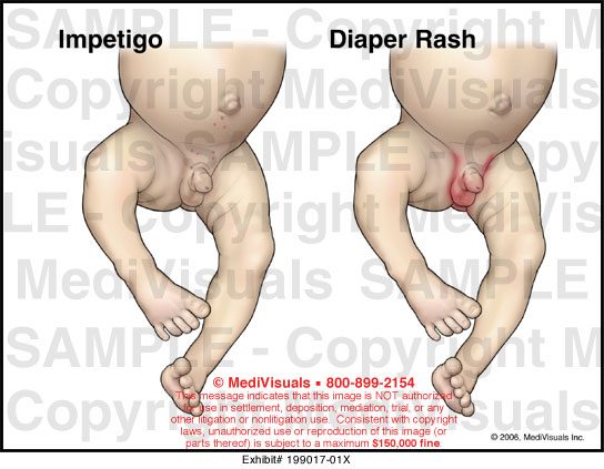 Impetigo Diaper Rash